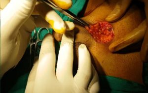 افزایش سایز آلات مردان به روش جراحی